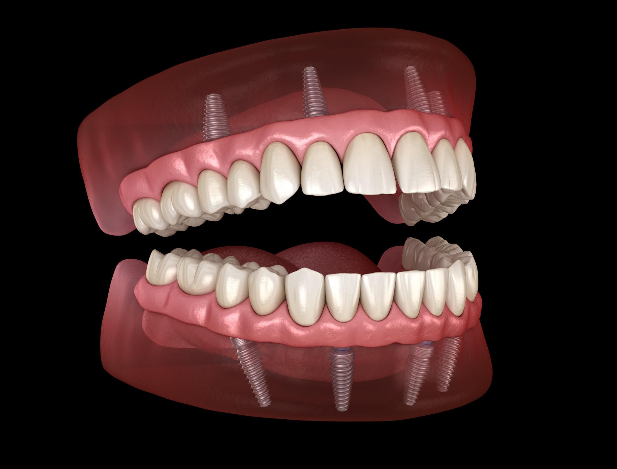 The link between bone grafts and dental implants